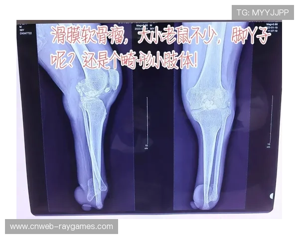 国家德比赛后卡瓦哈尔需接受膝盖手术,关节游离体问题影响职业生涯